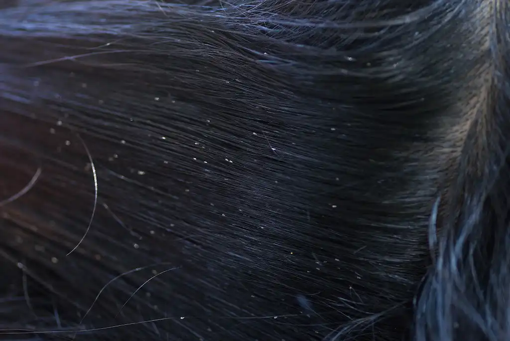 Mild vs Severe Lice Infestation LiceDoctors